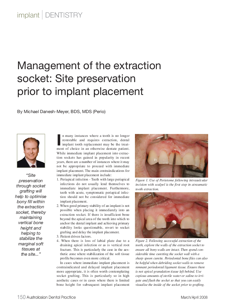Tooth Extraction and Socket augmentation prior to implant placement cover image