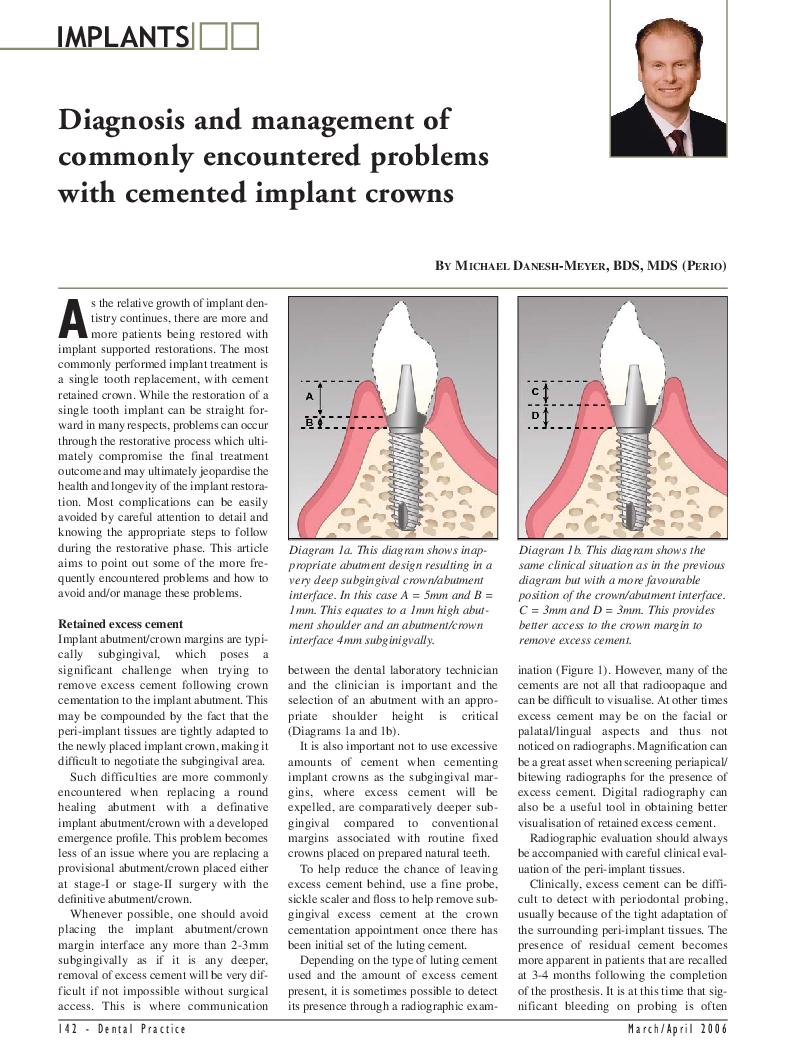Single tooth Implant Prosthetics- cement retained single tooth implants cover image