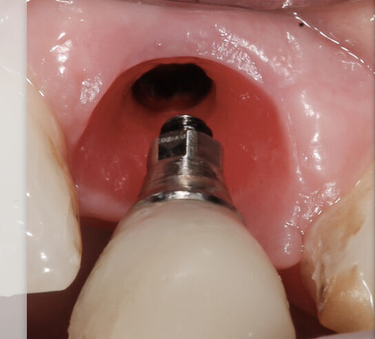Restoring Single Tooth Dental Implants