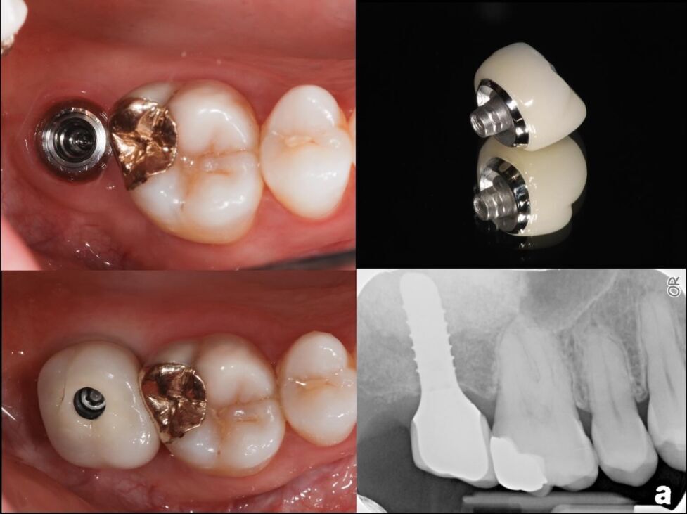 Restoring single tooth implants with the Straumann Implant system