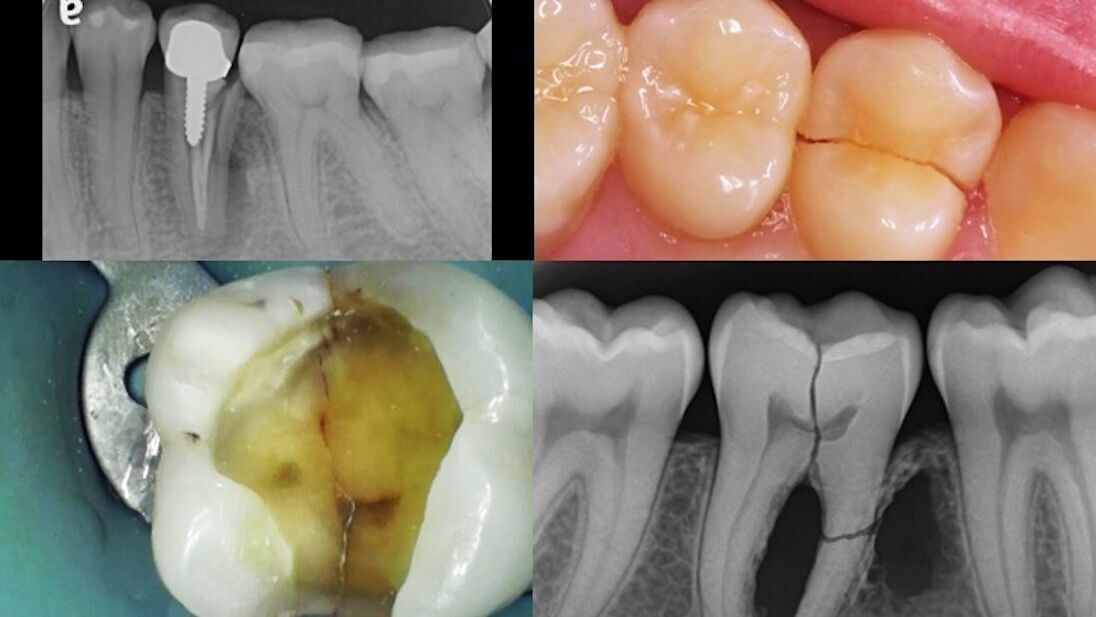 Auckland Endodontic Study Club- Tooth Fracture & Cracked Tooth Syndrome- Diagnosis & Management